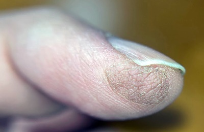 皮膚移植された指